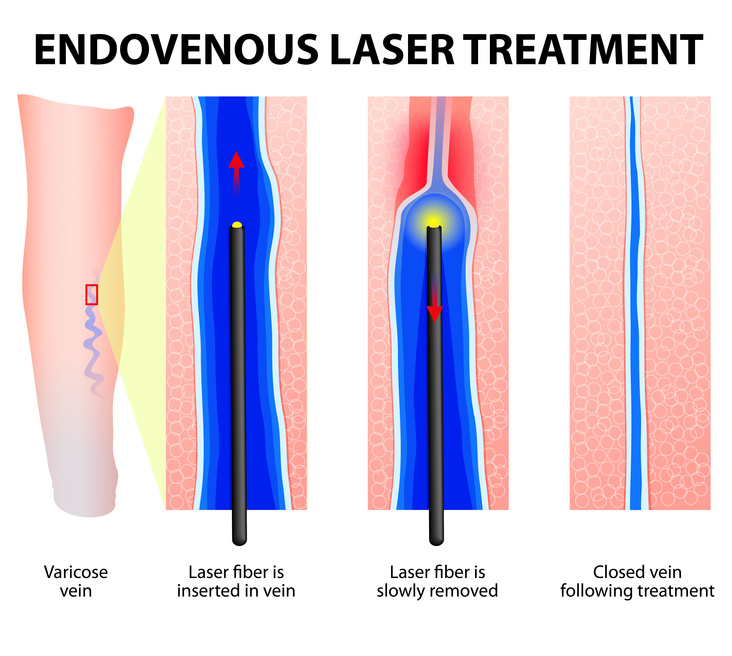 Varicose Veins