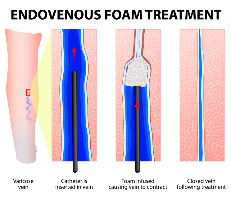 Varicose Veins. Endovenous foam Treatment. When injected inside a vein, the micro foam displaces the blood creating better contact with the vein wall. Sclerosant seals off the varicose veins.